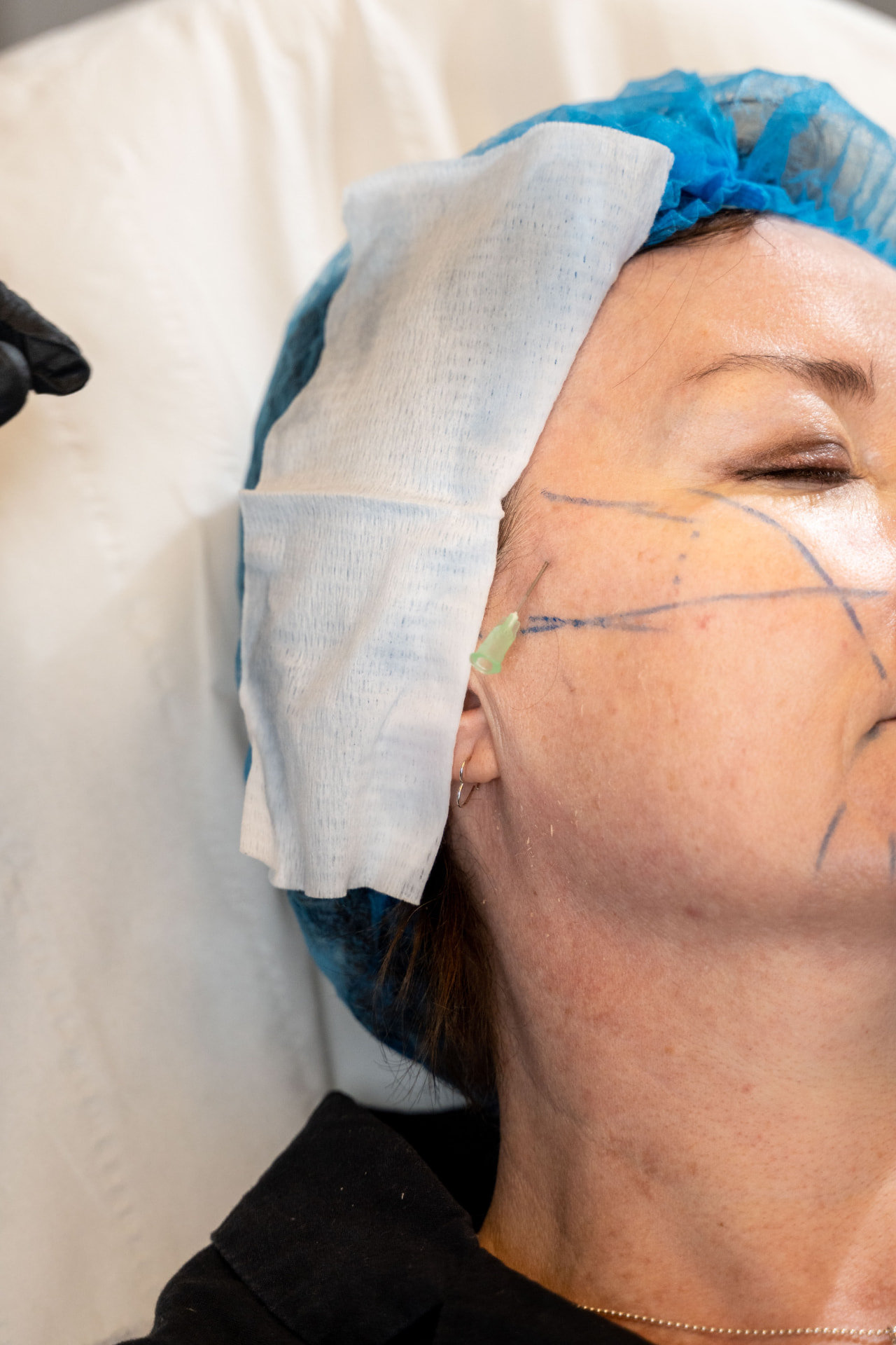 Facial anatomy mapped out on a patient before treatment